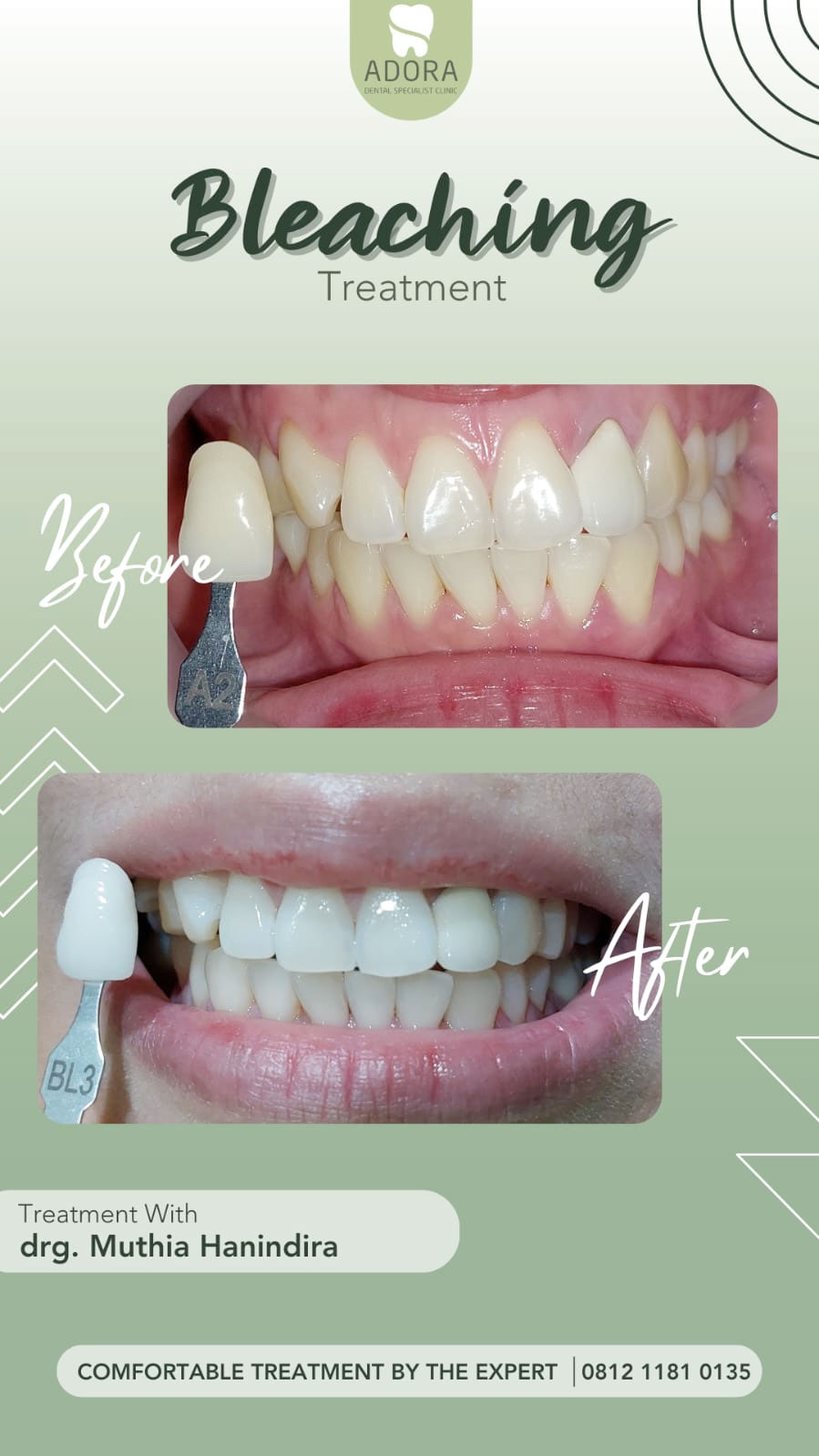 Bleaching Treatment - Adora Dental Specialist Clinic