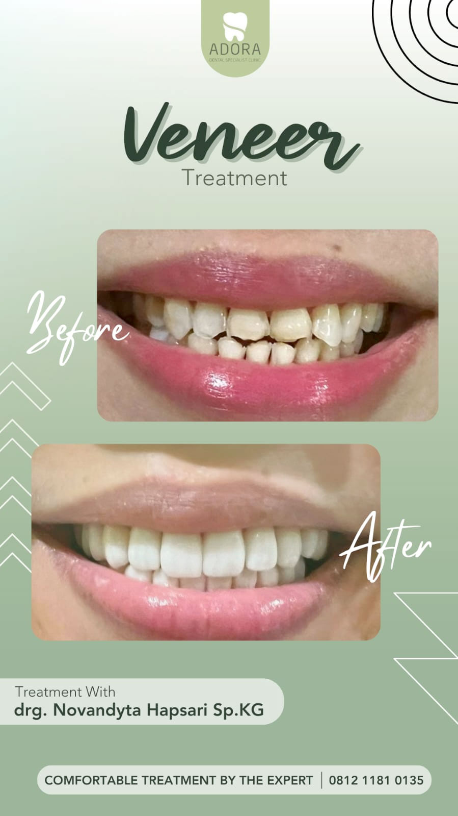 Veneer - Adora Dental Specialist Clinic