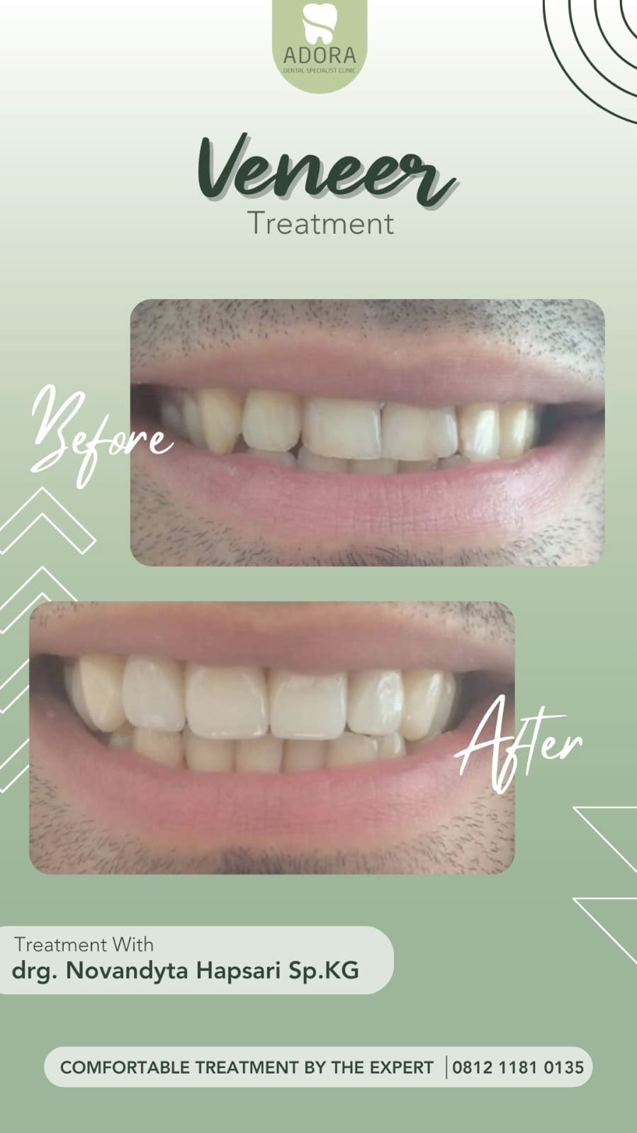 Veneer - Adora Dental Specialist Clinic